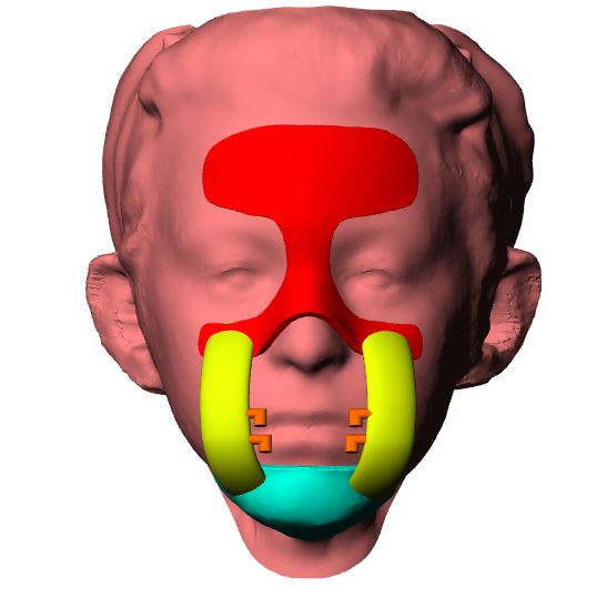 Design and manufacturing of a fully digital protraction facemask